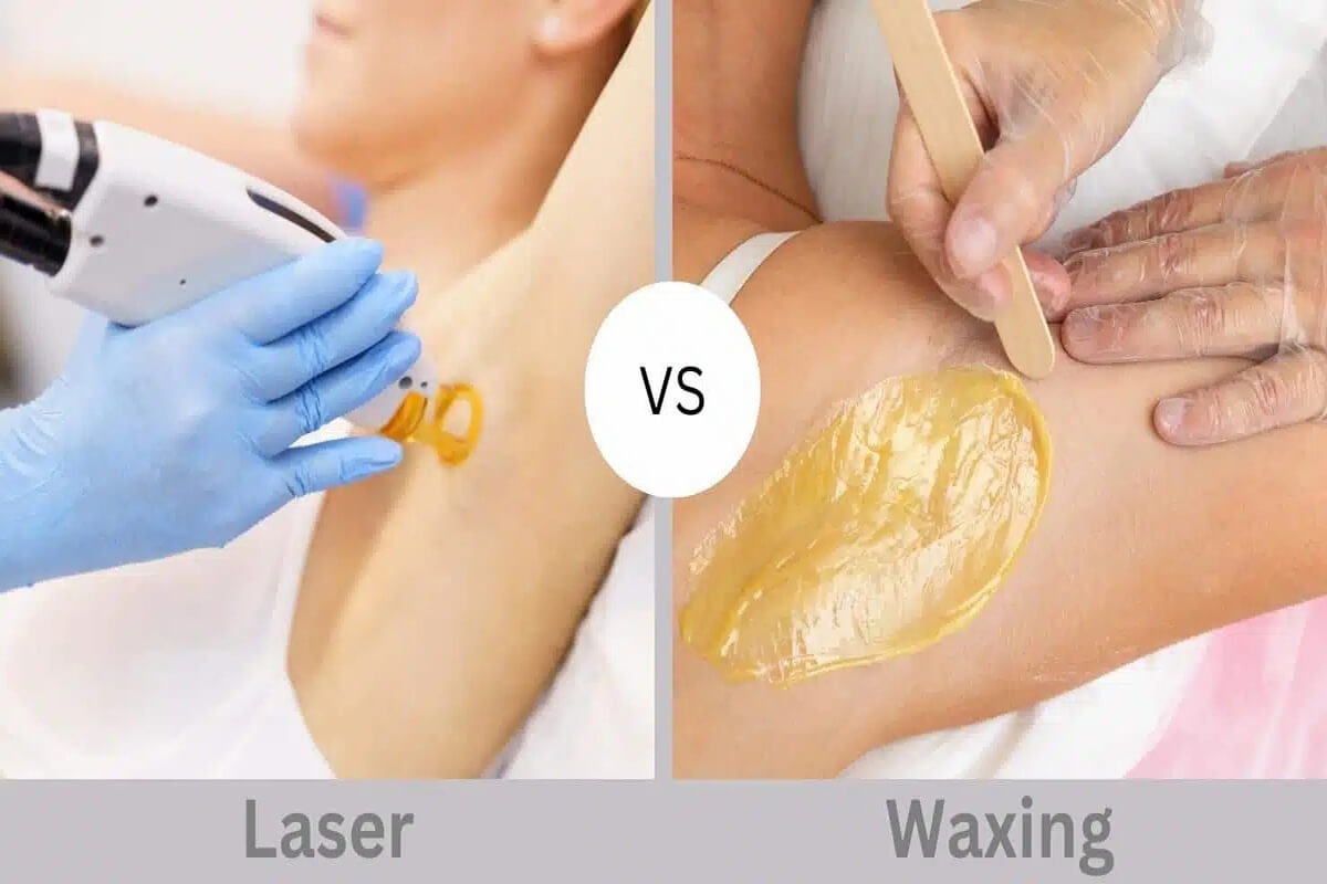 Laser vs. Waxing